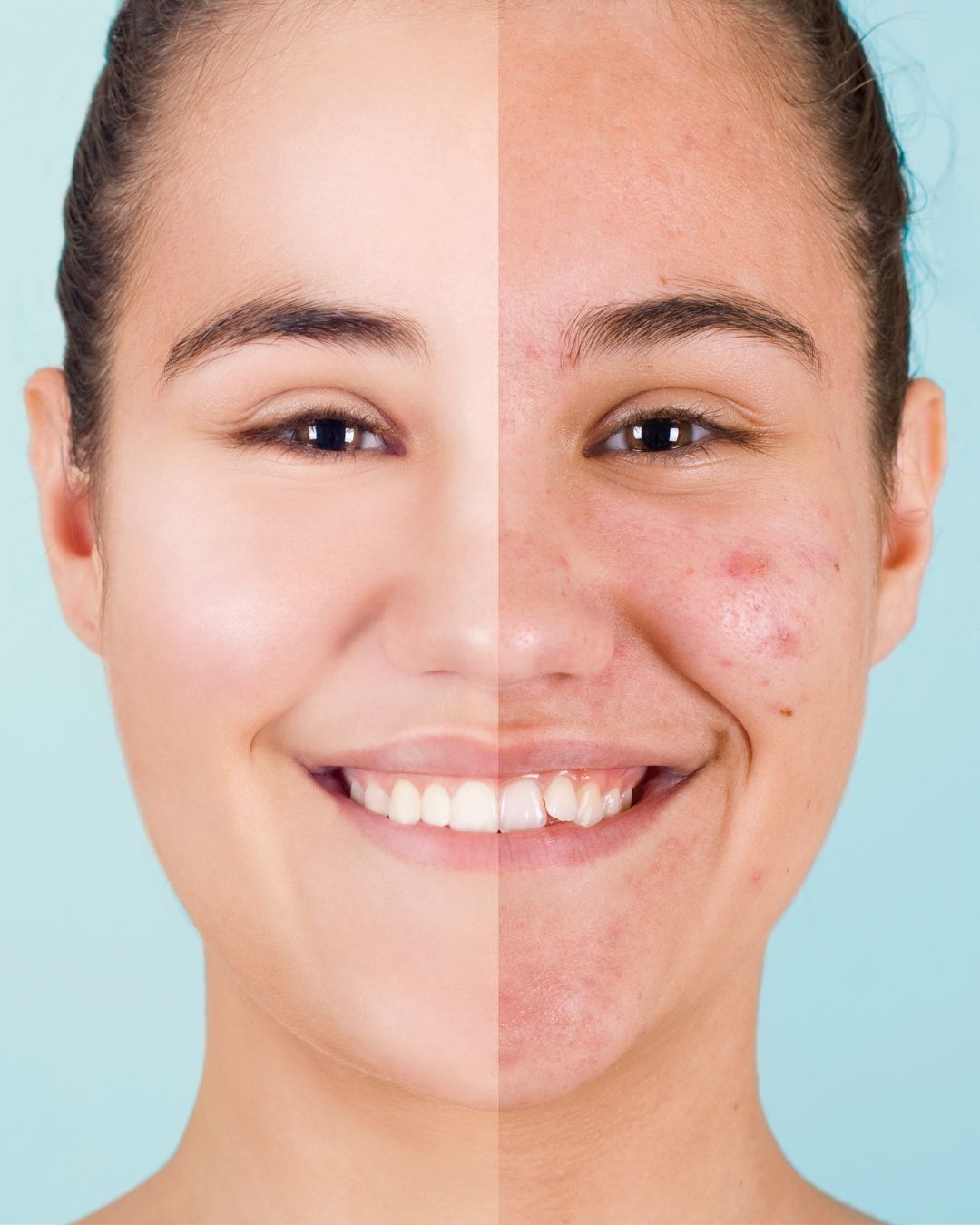 Acne Control Protocol