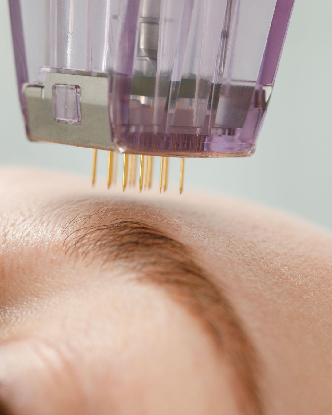 Microneedling